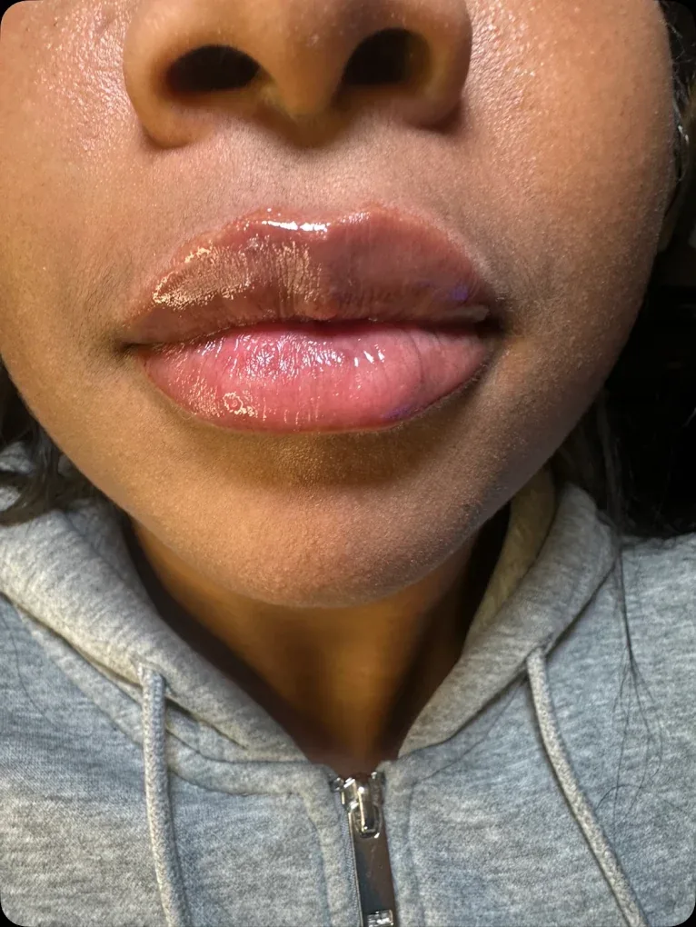 Lip filler